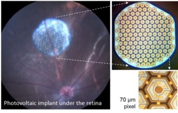 Retinal Implants